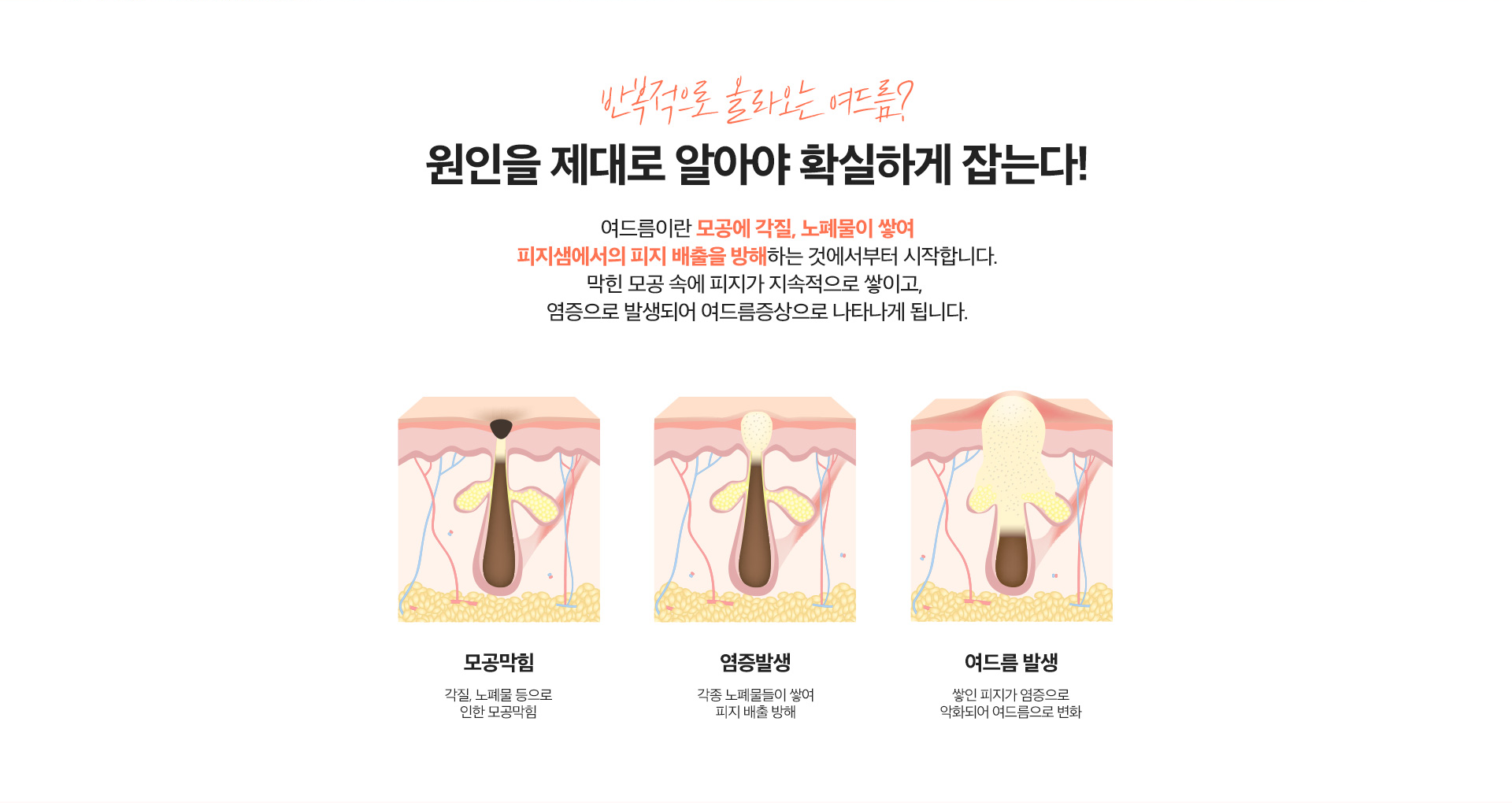 리엔장 여드름케어 원인
