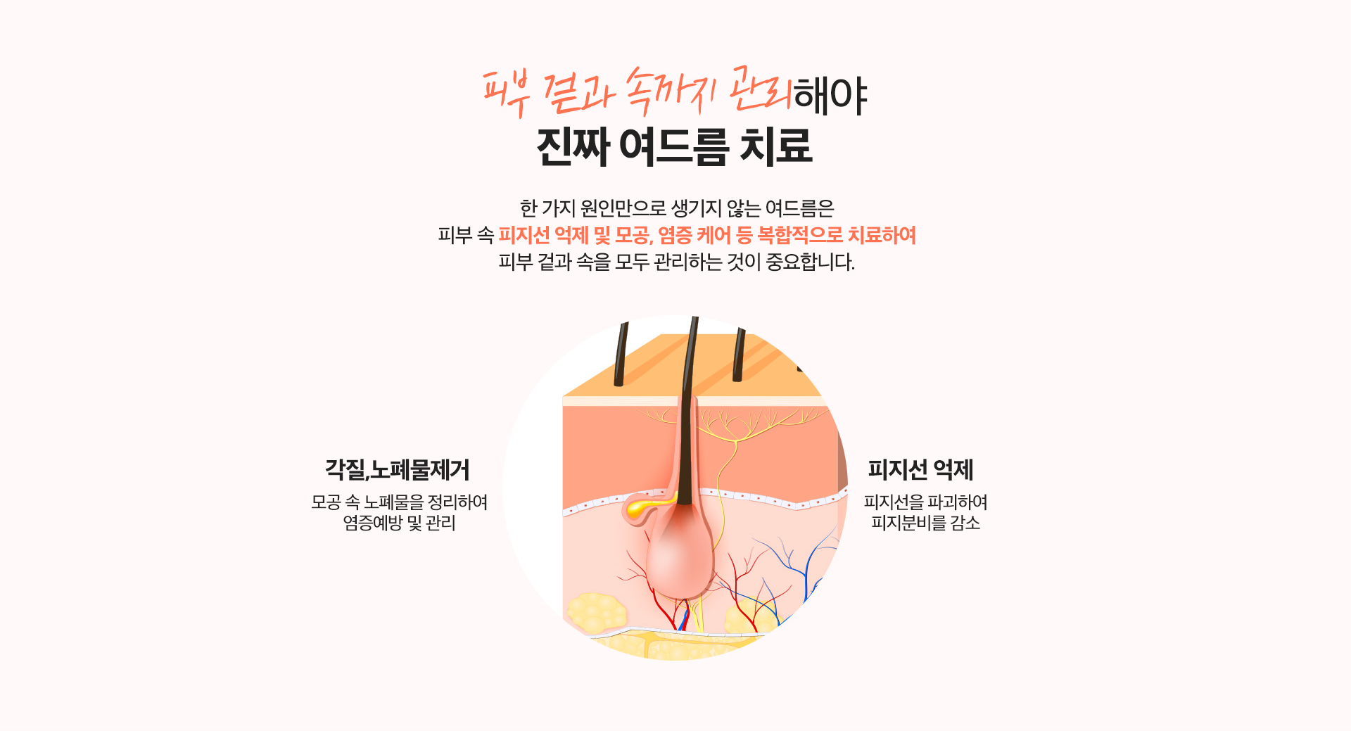 리엔장 여드름케어 치료방법