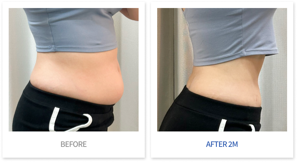 바디 시술 전후 비교 1