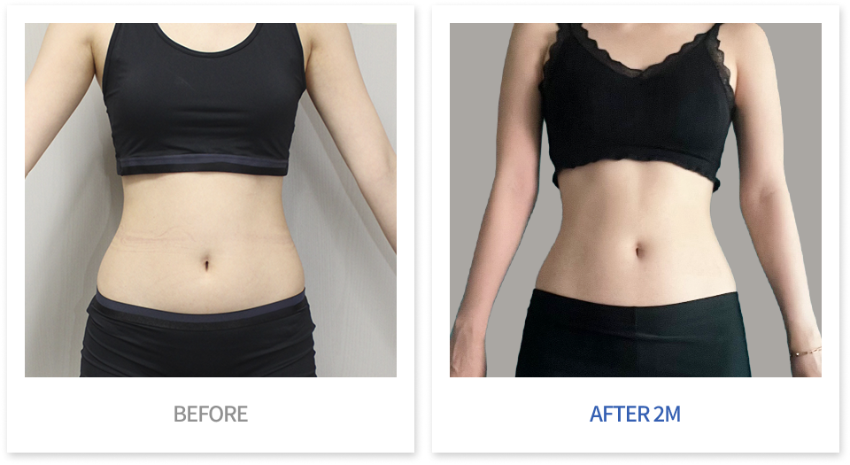 바디 시술 전후 비교 2