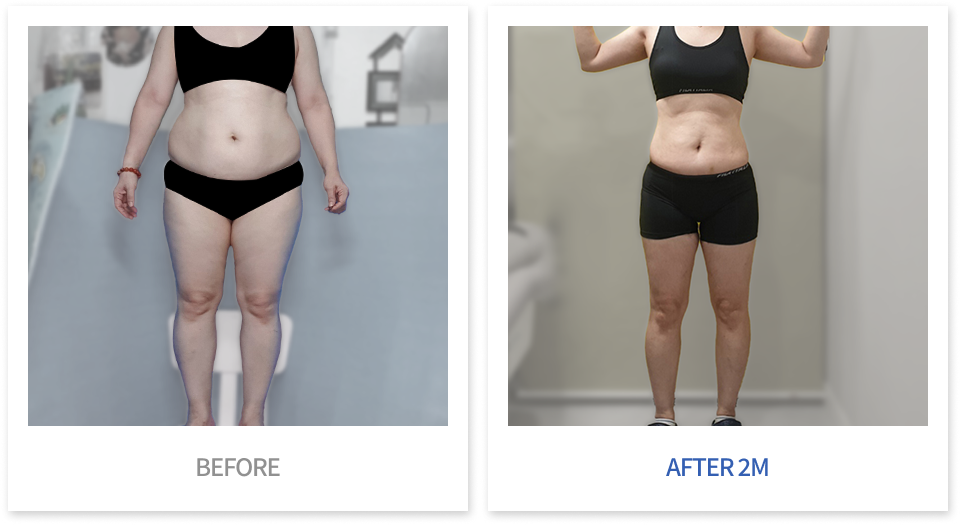 바디 시술 전후 비교 3