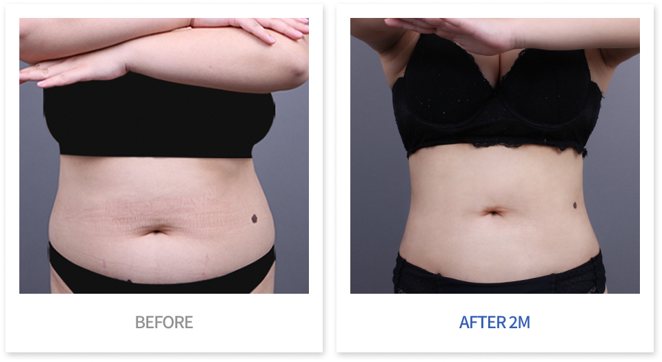 바디 시술 전후 비교 4