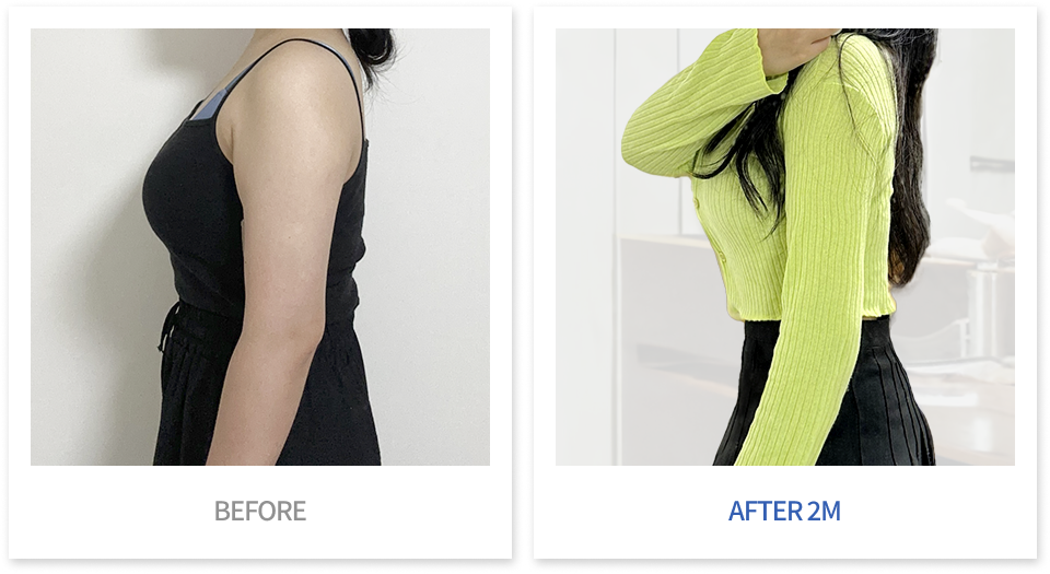 바디 시술 전후 비교 5