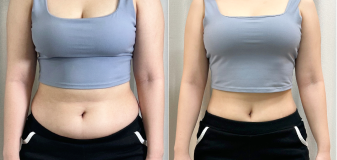 바디 시술 전후 썸네일 1