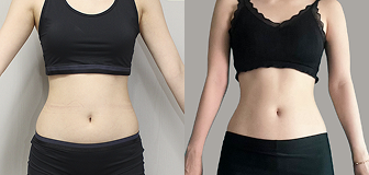 바디 시술 전후 썸네일 2