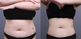 바디 시술 전후 썸네일 4