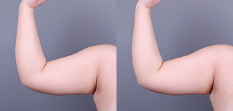 바디 시술 전후 썸네일 6