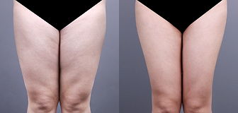 바디 시술 전후 썸네일 7