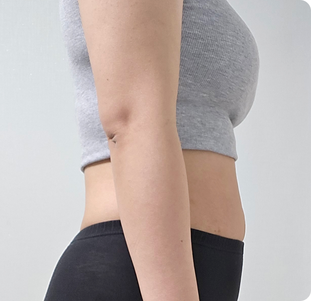 복부전체, 러브핸들 시술 후