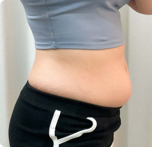 복부전체, 러브핸들, 뒷구리 시술 전